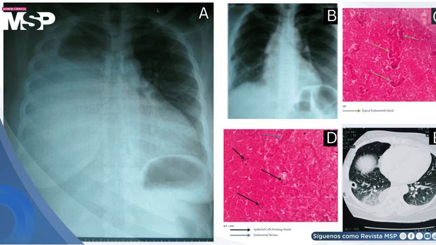 Hemotórax catamenial por endometriosis torácica como causa de disnea y dolor torácico cíclico en paciente
