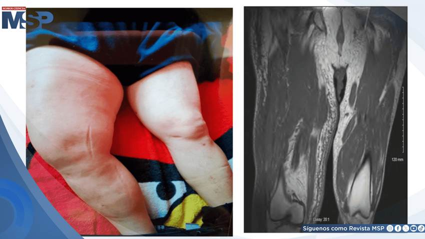 Identifican infarto muscular diabético en paciente con masa dolorosa en muslo y diabetes no controlada