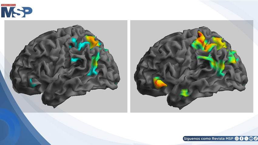 Ketamina sublingual logra remisión completa en paciente con síndrome de cabeza explosiva