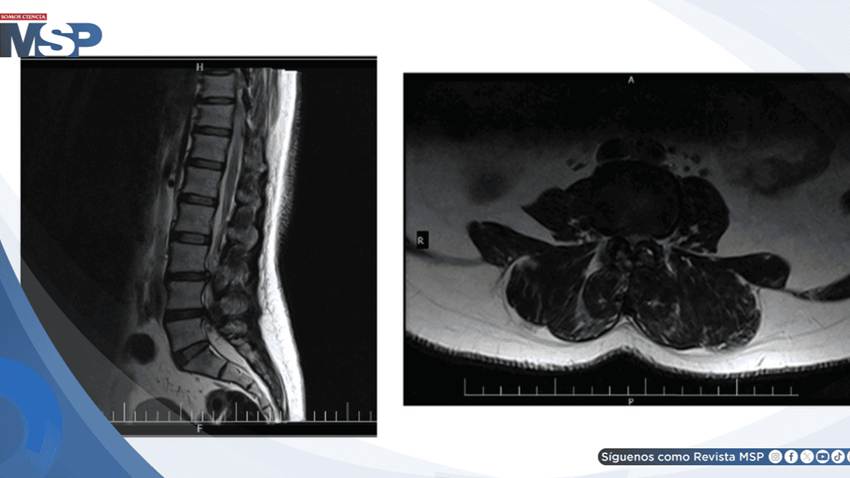Tratamiento con ejercicio PKE logra recuperación funcional en hernia discal lumbar con ciatalgia