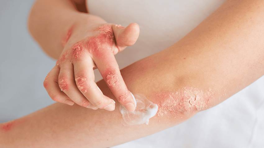 Picazón, dolor y piel enrojecida: síntomas de la dermatitis atópica