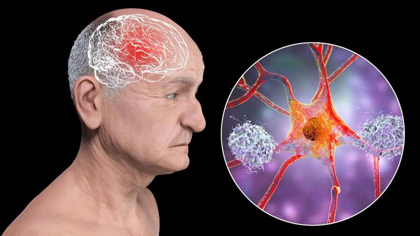 Estas son las enfermedades cardiovasculares que  se relacionan con el deterioro cognitivo y la demencia