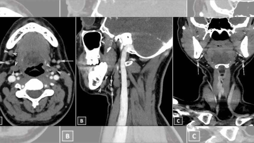 Describen raro caso de aplasia bilateral de la glándula submandibular