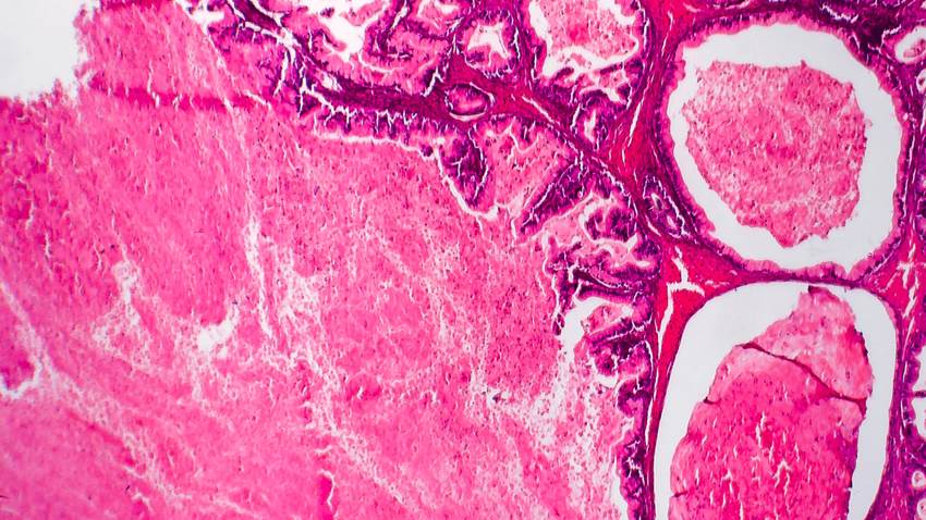 Anticuerpos generados por el sistema inmunitario combaten los tumores de ovario, según estudio