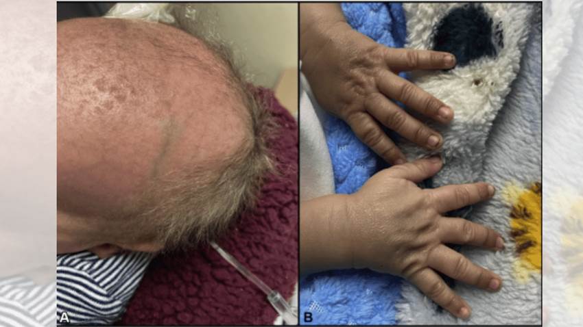 Tratan raro caso de enfermedad de Menkes en paciente pediátrico con micrognatia en Puerto Rico