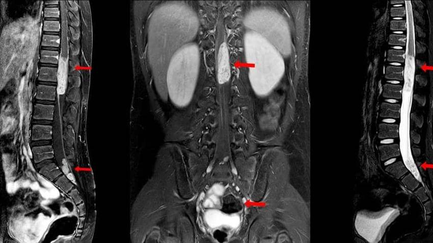 La FDA levantó las restricciones sobre el sistema de estimulación de la médula espinal
