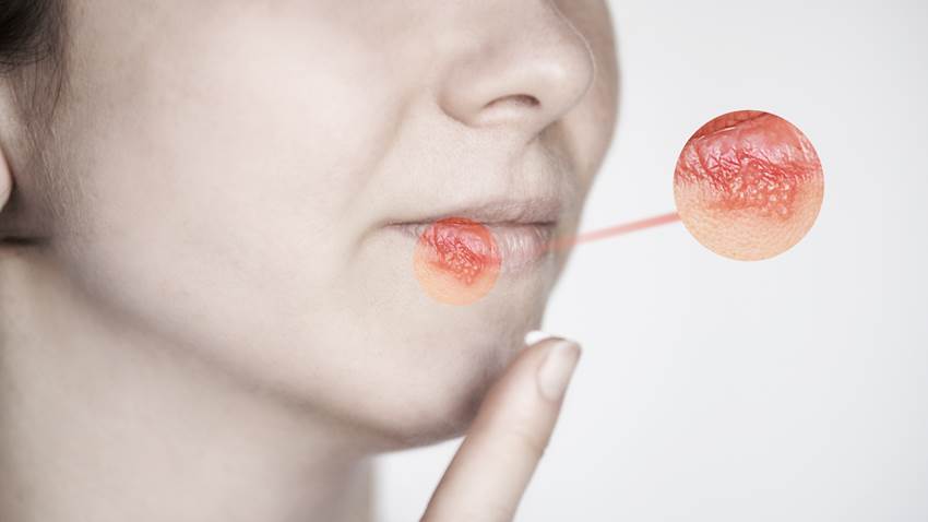 ¿Puedo contraer una enfermedad de transmisión sexual usando condón?