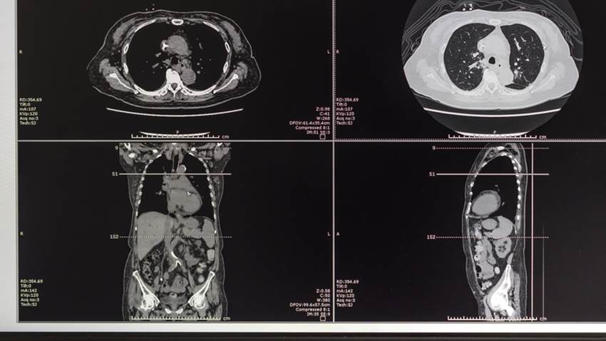 Describen nueva variante genética de autismo en Puerto Rico