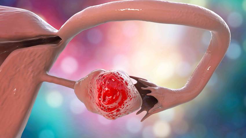 Reconoce los síntomas comunes en el cáncer de ovario de alto riesgo en etapa temprana