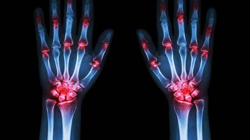 Estudio confirma la eficacia de Guselkumab en pacientes con artritis psoriásica