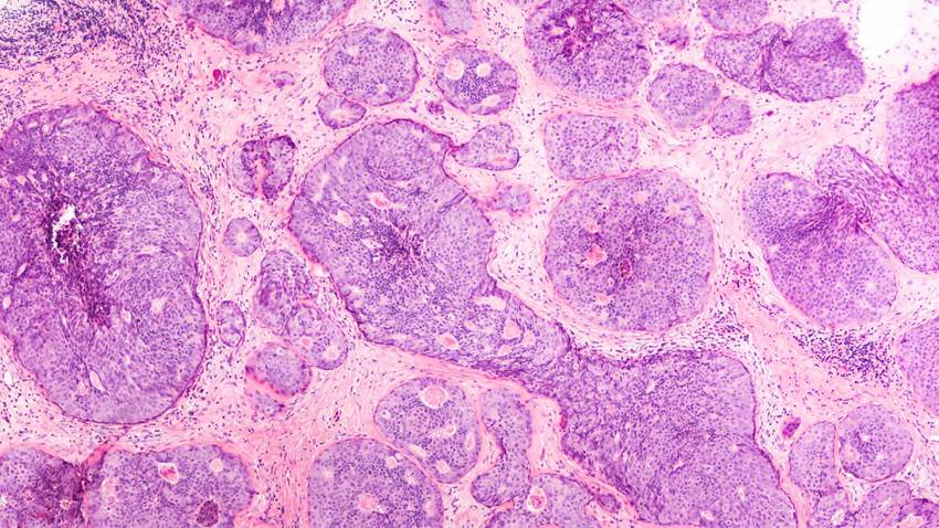 Un ensayo clínico de fase III acerca la cura del cáncer de mama metastásico