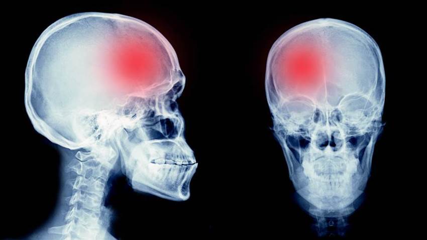 Existe un alto riesgo de epilepsia 1 año después del accidente cerebrovascular, según estudio