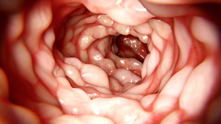 Dieta de exclusión en enfermedad de Crohn lograría remisión leve o moderada, según estudio