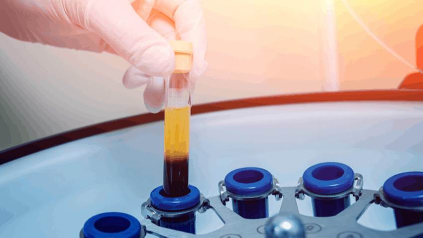 Tratamientos a base de plasma contra COVID-19 sería benéfico únicamente en pacientes con fases iniciales