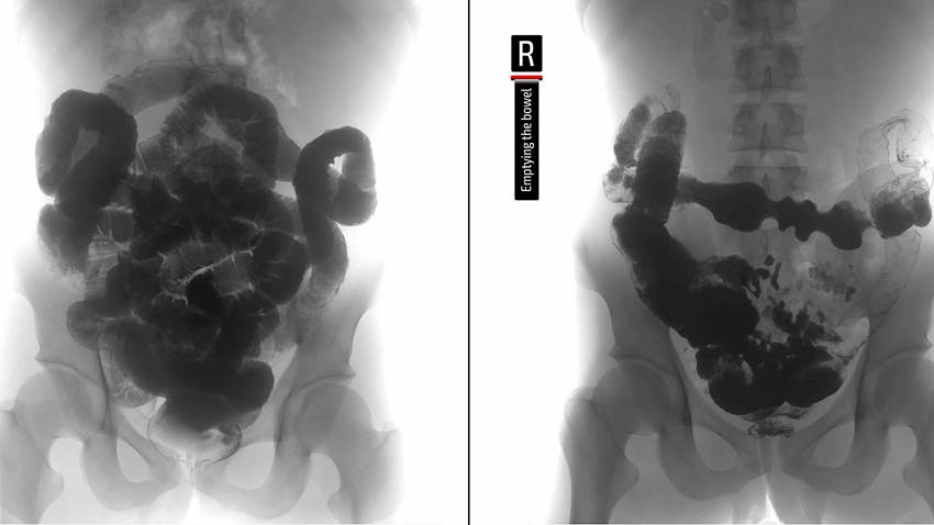 Terapias avanzadas para la enfermedad intestinal inflamatoria