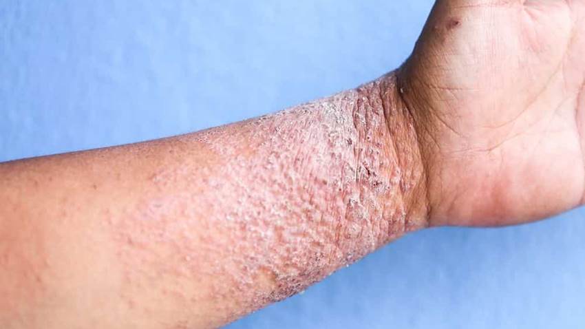 La FDA aprobó el Tralokinumab para adultos con dermatitis atópica de moderada a grave