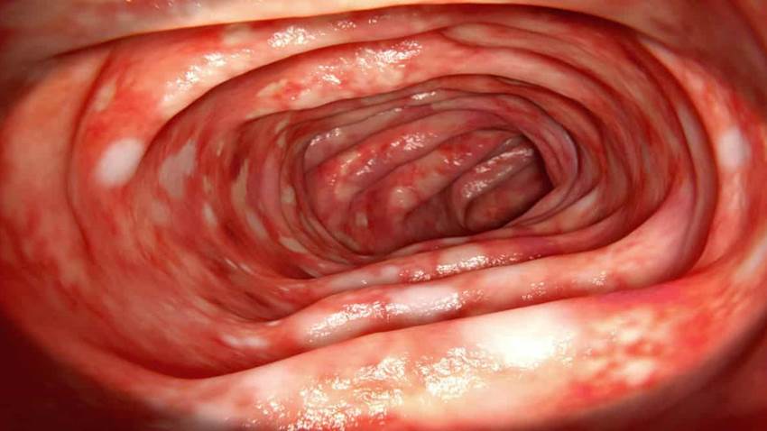Diagnósticos diferenciales en las Enfermedades Inflamatorias del Intestino