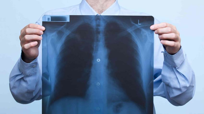 Umbrales de dímero D descartan tromboembolia pulmonar, según estudio