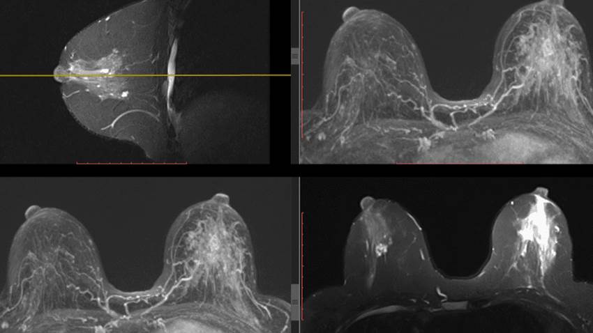 Vacuna experimental contra el cáncer de mama demuestra seguridad en primera fase de ensayos clínicos