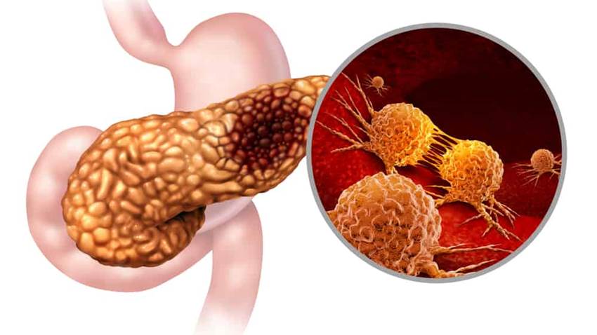 Ascendente la letalidad del cáncer de páncreas en Puerto Rico y baja supervivencia, según estudio