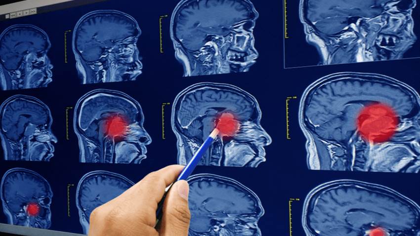 Nueva terapia para tratar los glioblastomas que son tumores cerebrales agresivos