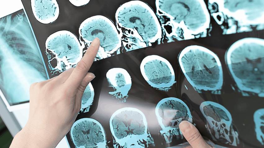 La vacuna de la COVID abre una nueva vía contra la esclerosis múltiple