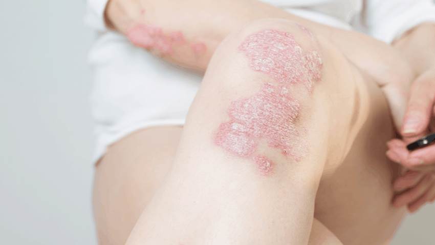 La Psoriasis genera un alto impacto psicológico en la vida de los pacientes, según expertos