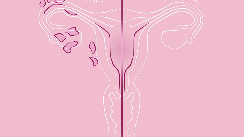 Actualizan guías para radioterapia del cáncer de endometrio