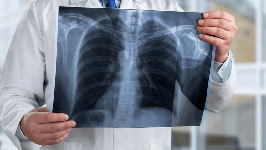 Pacientes con cáncer de pulmón tienen mayor riesgo de desarrollar COVID-19 severo, reveló estudio