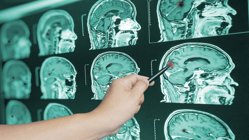 Síntomas que produce el sangrado en el interior del cerebro