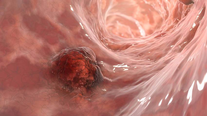 Nuevas directrices para el tratamiento del cáncer colorrectal de aparición temprana