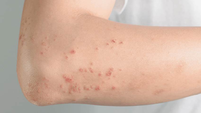 Lesiones en la piel puede ser síntoma de COVID-19