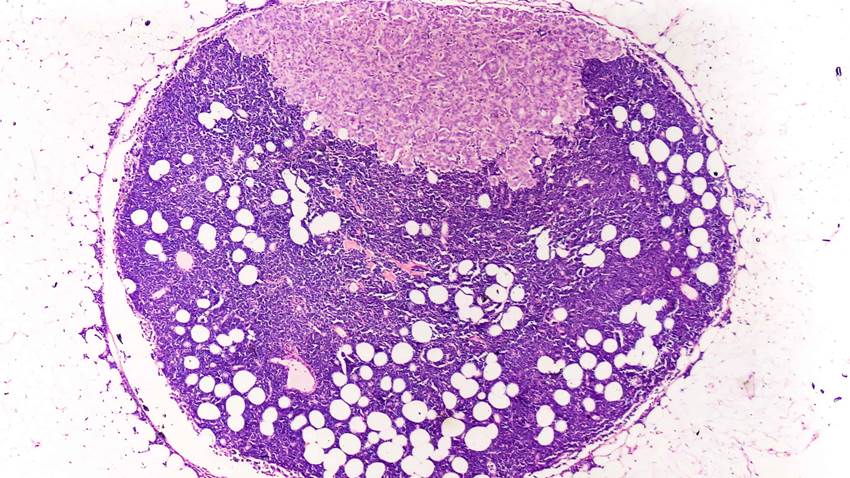 La propagación metastásica del cáncer de mama se acelera durante el sueño