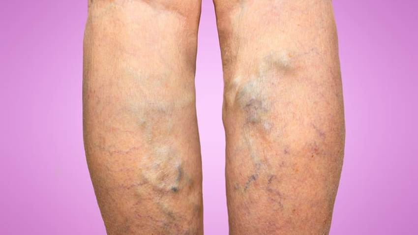 La lucha entre la fuerza de gravedad y el cuerpo: ¿Qué son las venas varicosas y  arañas vasculares?