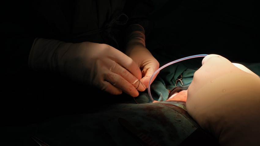 Mastectomía: procedimiento de preferencia para determinados tumores desarrollados en la mama