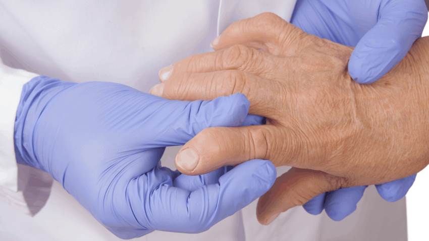 Baricitinib y tofacitinib podrían ser efectivos en tratamiento clínico contra la artritis reumatoide