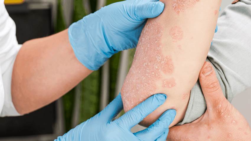 Abuso de alcohol y obesidad serían factores como déficit en eficacia de tratamientos en psoriasis