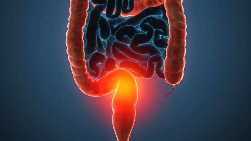 Factores de riesgo relacionados con el cáncer colorrectal