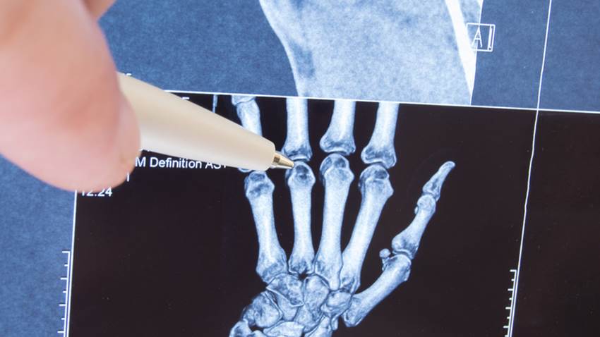 Aprobada cuarta indicación de XELJANZ® para el tratamiento de la artritis idiopática juvenil