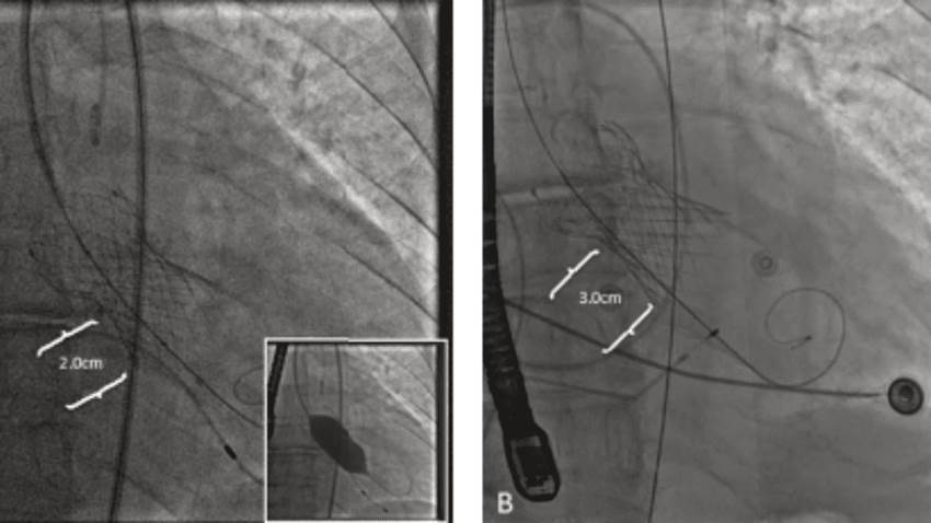 Primer tratamiento exitoso de fuga paravalvular severa utilizando la técnica de doble trampa