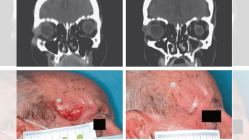 Terapia con cemiplimab se asoció a mejora completa en pacientes con carcinoma epidermoide cutáneo