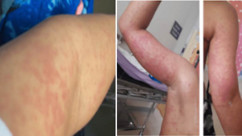 Raro caso de dermatitis por exposición a algas en Puerto Rico