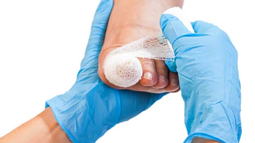Infecciones: El principal riesgo de las uñas encarnadas en pacientes diabéticos