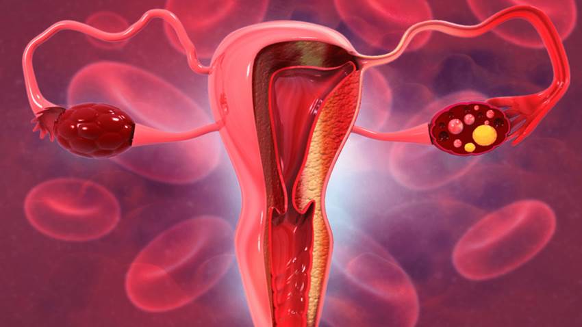 Síndrome de Rokitansky: la condición que provoca que las mujeres nazcan sin útero ni canal vaginal