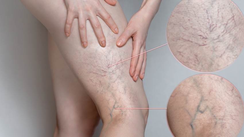 Embolias trombovenosas no tratadas pueden poner en riesgo la vida del paciente