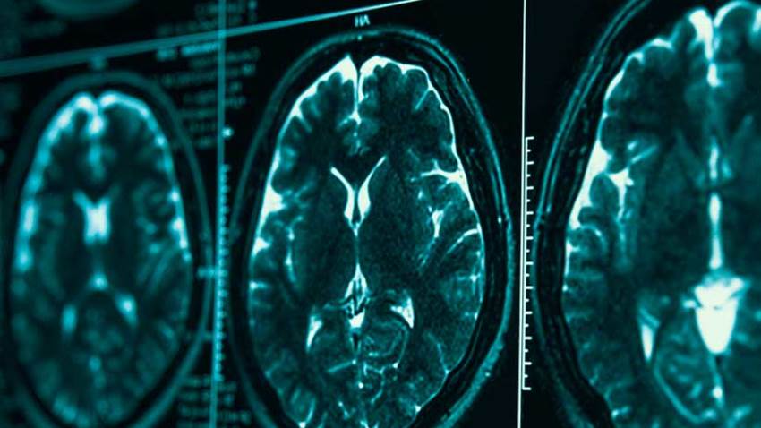 Vinculan la falta de calidad del sueño al riesgo de alzhéimer