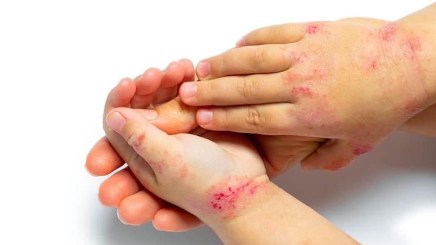 Riesgo del virus del herpes e infecciones graves en la dermatitis atópica