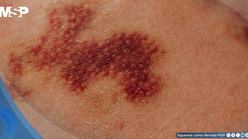 Vacuna contra el melanoma muestra resultados positivos en fase III, pero expertos piden cautela