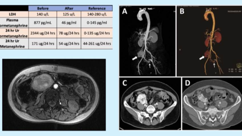 Médicos descubren tumor en zona lumbar de paciente puertorriqueño debido a fuertes dolores